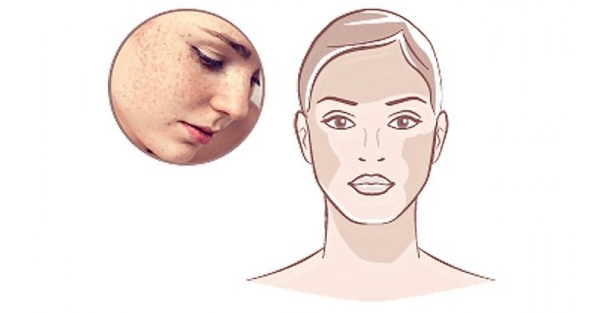 Hyperpigmentation